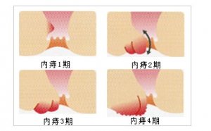 福州痔疮内痔主要症状
