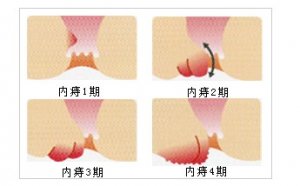 福州痔疮内痔出血怎么办