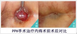 福州痔疮内痔主要症状