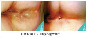 福州治疗肛周脓肿哪里好?