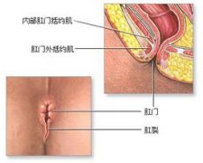 福州肛裂去哪家医院治效果果好