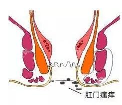 尴尬的痛苦——肛门瘙痒该怎么办？