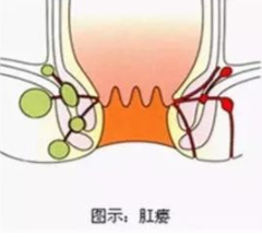 福州治肛瘘效果好的医院