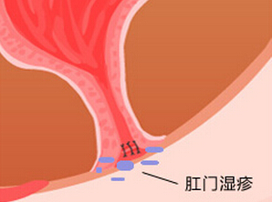 在福州得了肛门湿疹怎么诊治?